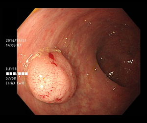 大腸ポリープの症例