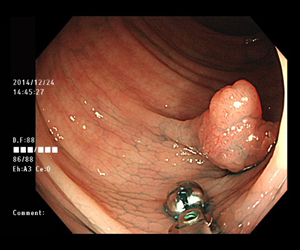 大腸ポリープの症例