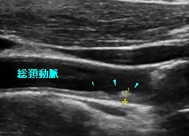 脂質（コレステロール、中性脂肪）異常